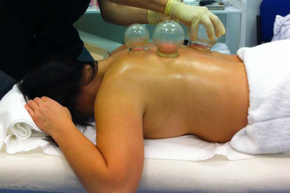 Cupping Therapy - Acupuncture